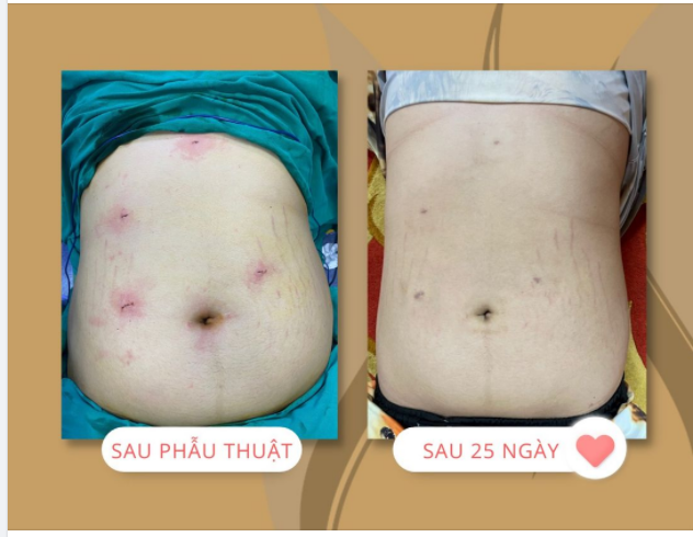 Nam bệnh nhân 18 tuổi với cân nặng 135kg, sau 25 ngày thực hiện Thu nhỏ Dạ dày giảm được 15kg