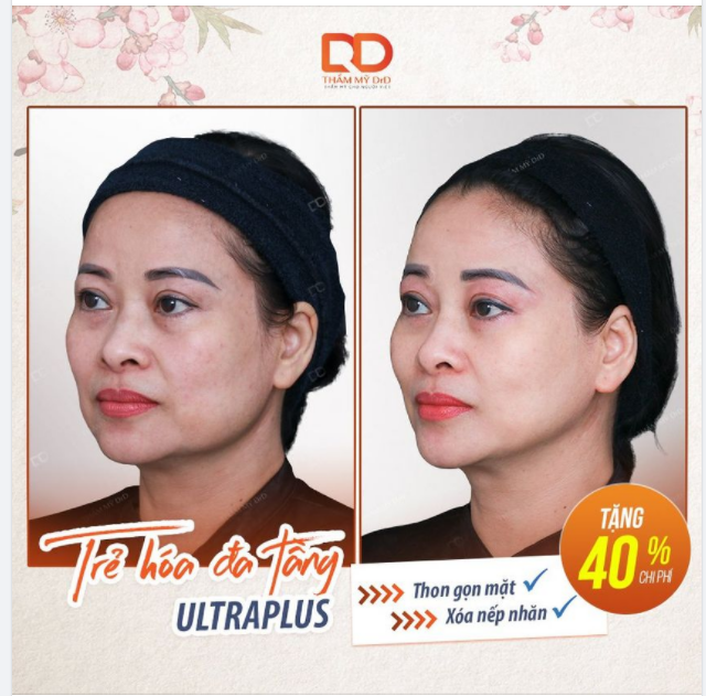 Nâng cơ trẻ hóa không phẫu thuật ULTRAPLUS Những điều bạn cần biết.