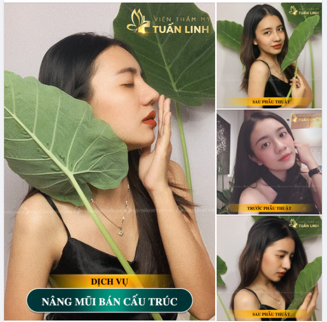 Nâng mũi bán cấu trúc lên dáng siêu xinh cả nhà ơi