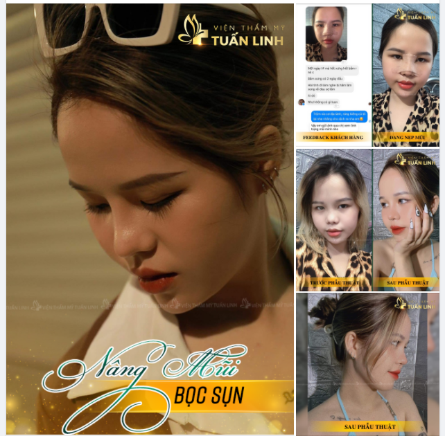 NÂNG MŨI BỌC SỤN - DÁNG MŨI SAU 3 THÁNG NÂNG TẠI TUẤN LINH.