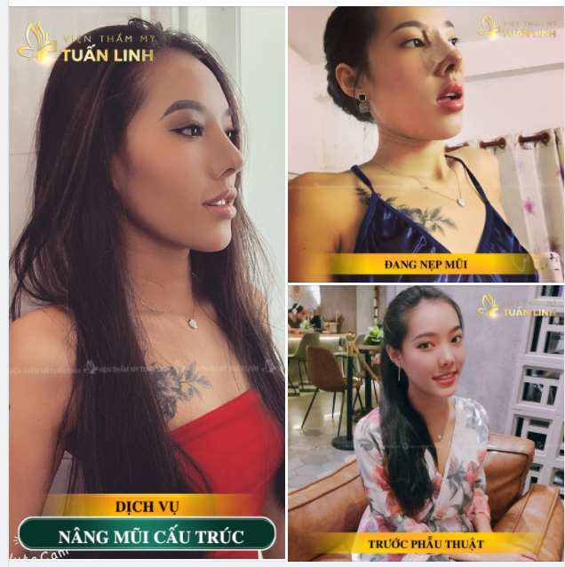Nâng mũi cấu trúc - Dáng mũi cao tây xinh đẹp tự nhiên một cách hoàn hảo.