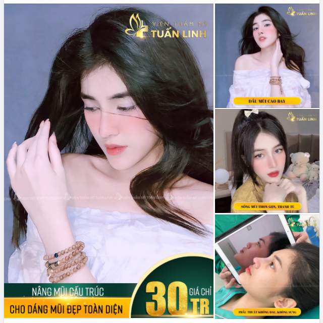 NÂNG MŨI CẤU TRÚC - GIÁ CHỈ 30TR - CHO DÁNG MŨI ĐẸP TOÀN DIỆN.