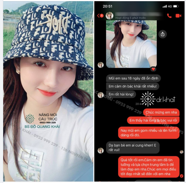 NÂNG MŨI CẤU TRÚC SAU 18 NGÀY Em rất hài lòng