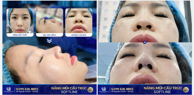 Nâng mũi cấu trúc Softline - Độc quyền Dr Vũ Quang có gì đặc biệt