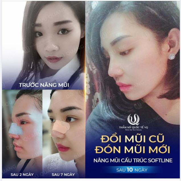 Nâng mũi cấu trúc Softline Kết quả sau 10 ngày sẽ như thế nào