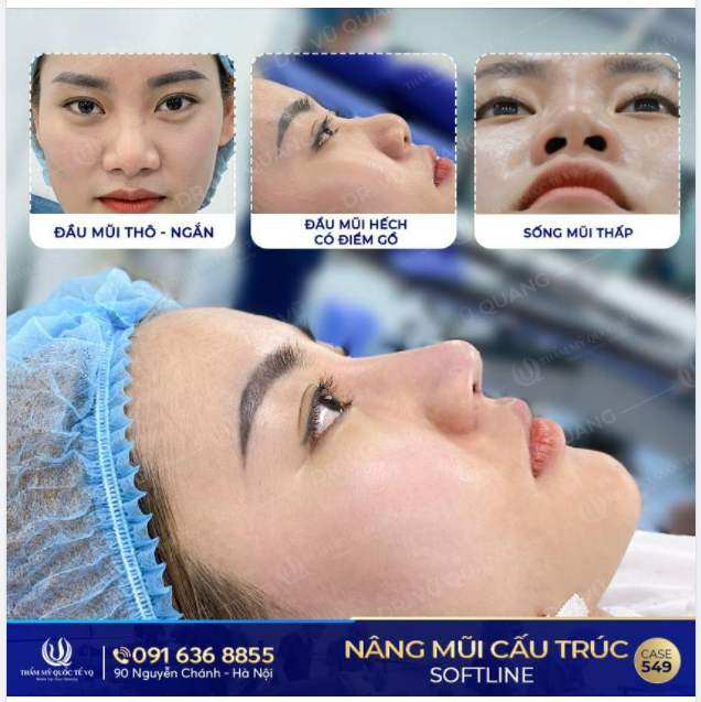 Nâng mũi cấu trúc Softline - Mũi đẹp chuẩn nhân trắc học