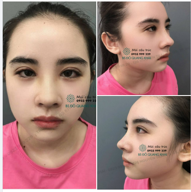 NÂNG MŨI CẤU TRÚC THON GỌN CHUẨN FORM NHÀ DR.KHẢI