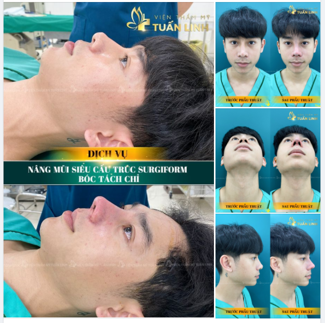 NÂNG MŨI CHỈ BỊ BIẾN CHỨNG... PHẢI SỬA LẠI VÀ CÁI KẾT