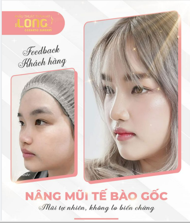 NÂNG MŨI KHÔNG PHẪU THUẬT MŨI ĐẸP NGAY CHỈ SAU 30 PHÚT