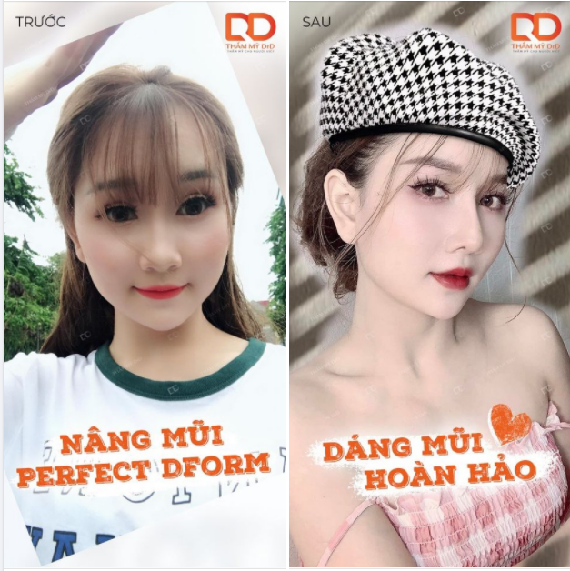 ​​​​​​​ Nâng mũi Perfect Dform - Tạo dáng lên form xuất sắc.