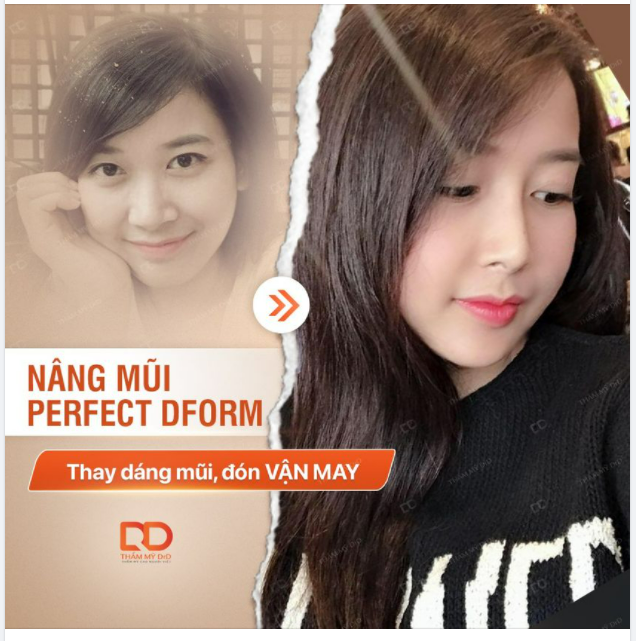 Nâng mũi Perfect Dform – Thay dáng mũi, đón vận may.