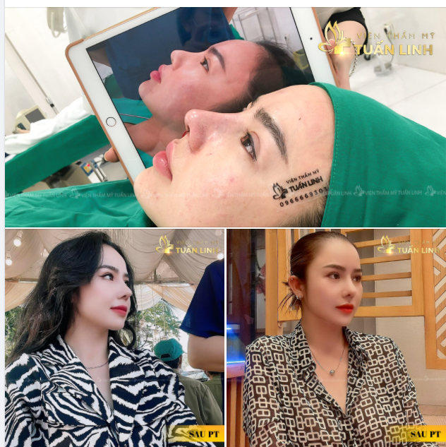 Nâng mũi siêu cấu trúc - Dáng đẹp sau 1 năm nâng mũi tại tuấn Linh