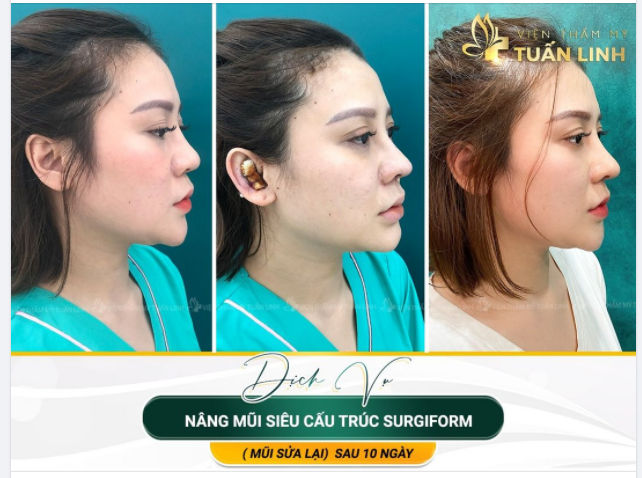 NÂNG MŨI SIÊU CẤU TRÚC ( MŨI SỬA LẠI) SAU 10 NGÀY.