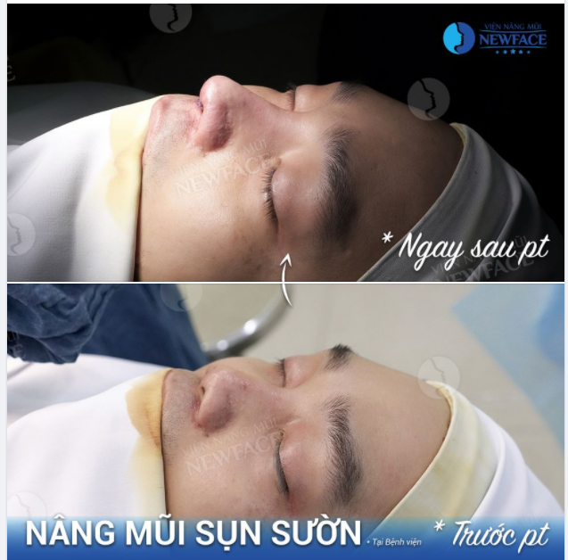 NÂNG MŨI SỤN SƯỜN CHO NAM DÁNG L LINE KHÁC BIỆT