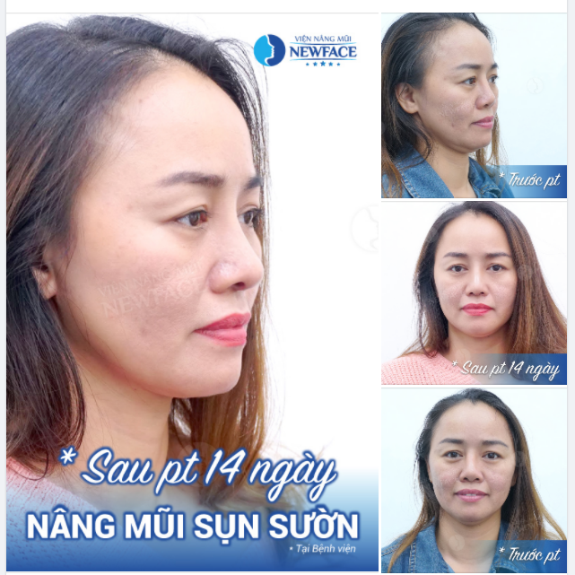 NÂNG MŨI SỤN SƯỜN CÓ THỰC SỰ KÉN TUỔI