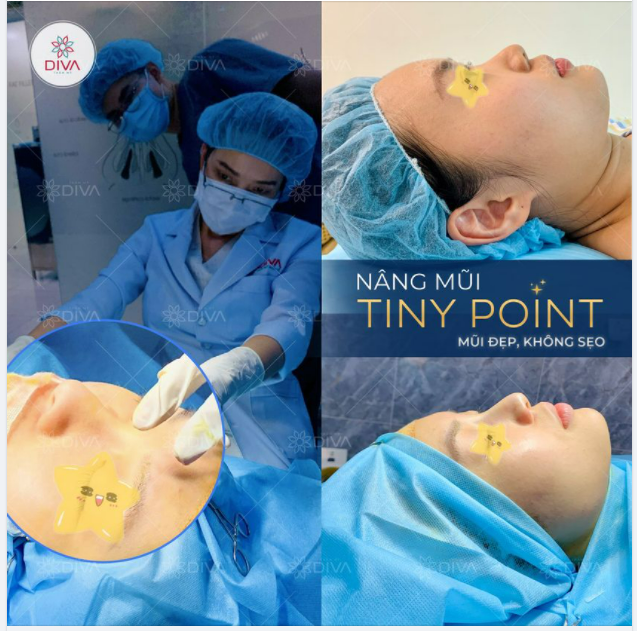NÂNG MŨI TINY POINT - MŨI ĐẸP KHÔNG SẸO SAU THỰC HIỆN