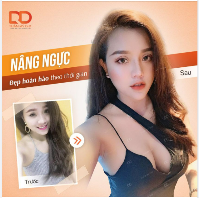 Nâng ngực – Đẹp hoàn hảo theo thời gian