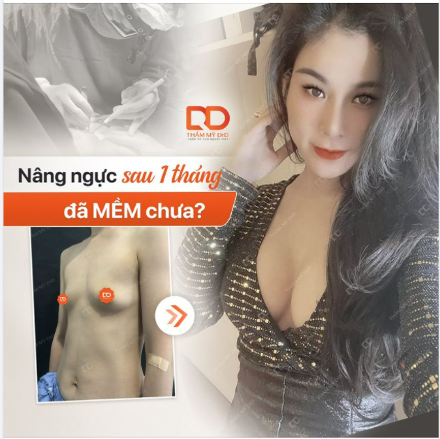Nâng ngực sau một tháng đã mềm chưa