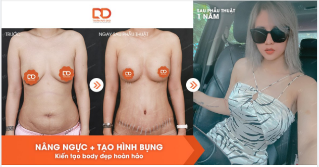 Nâng ngực + Tạo hình thành bụng = Kiến tạo body đẹp hoàn hảo.