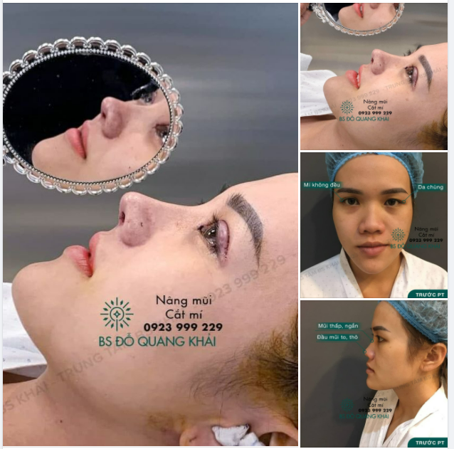 Nghẹn ngào vì kết quả quá hài lòng của chị KH ngay tại bàn mổ