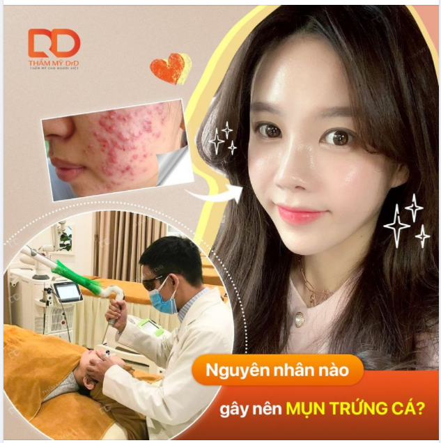 Nguyên nhân nào gây mụn trứng cá