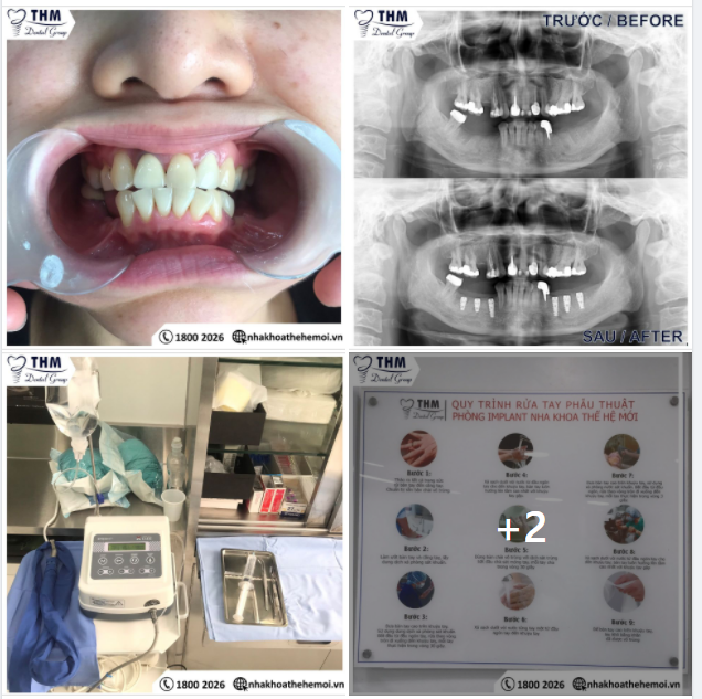 NHA KHOA UY TÍN CHẤT LƯỢNG CAO - IMPLANT GIÁ TỐT CA LÂM SÀNG CẤY GHÉP 6 TRỤ IMPLANT SWITZERLAND