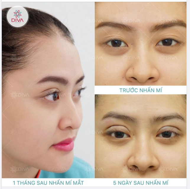 NHẤN MÍ MẮT - PHƯƠNG PHÁP AN TOÀN ĐỂ SỞ HỮU ĐÔI MẮT ĐẸP