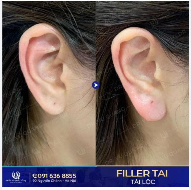 Nhân tướng xem tai Dái tai dày dặn, tài lộc sum suê Vạn điều may mắn