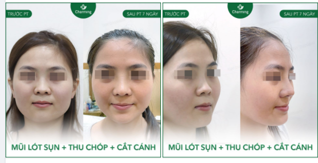 Nhiều người thích mũi thật cao, thật bay thì sẽ trung thành với phương pháp nâng mũi cấu trúc.