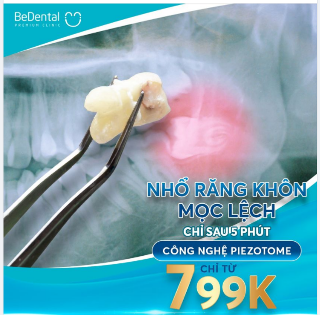 Nhổ răng khôn mọc lệch sau 5p với bác sĩ 15 năm kinh nghiệm
