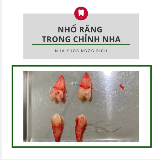 NHỔ RĂNG TRONG CHỈNH NHA