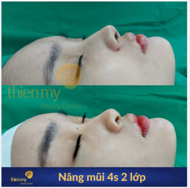 Những Khách hàng vốn đã sở hữu ngũ quan xinh đẹp, chỉ cần một thay đổi nhỏ ở phần sống mũi thôi cũng đã khiến cho gương mặt bạn quyến rũ cá tính hơn nhiều!