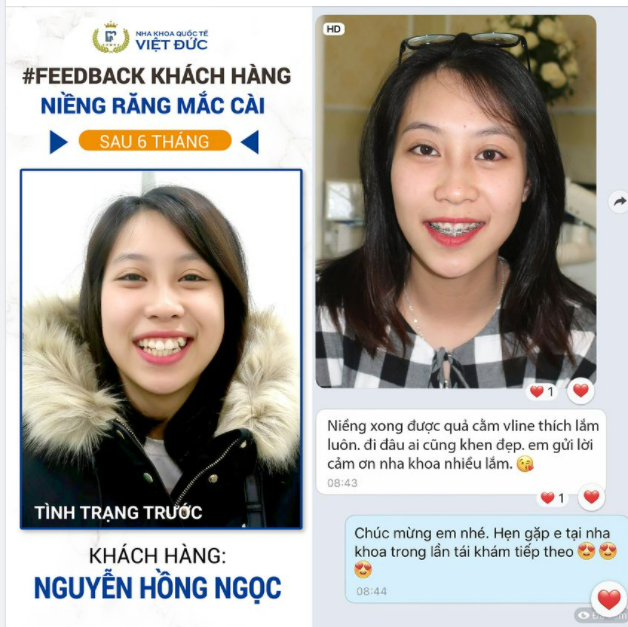 NIỀNG 1 ĐƯỢC 2 NIỀNG RĂNG XONG ĐƯỢC CẢ CẰM CHUẨN V-LINE