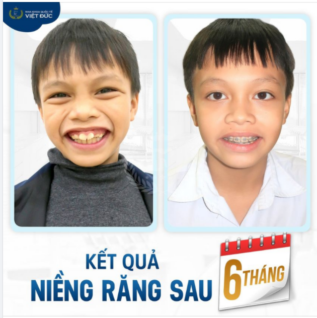 NIỀNG RĂNG CÀNG SỚM - HIỆU QUẢ CÀNG CAO