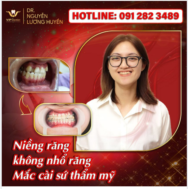 NIỀNG RĂNG CHẲNG SỢ BỊ SOI MÓI, TRÊU ĐÙA, BÍ QUYẾT CỦA CÔ NÀNG 9X NẰM Ở LỰA CHỌN NÀY!