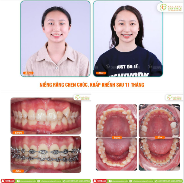 NIỀNG RĂNG CHEN CHÚC, KHẤP KHỂNH SAU 11 THÁNG