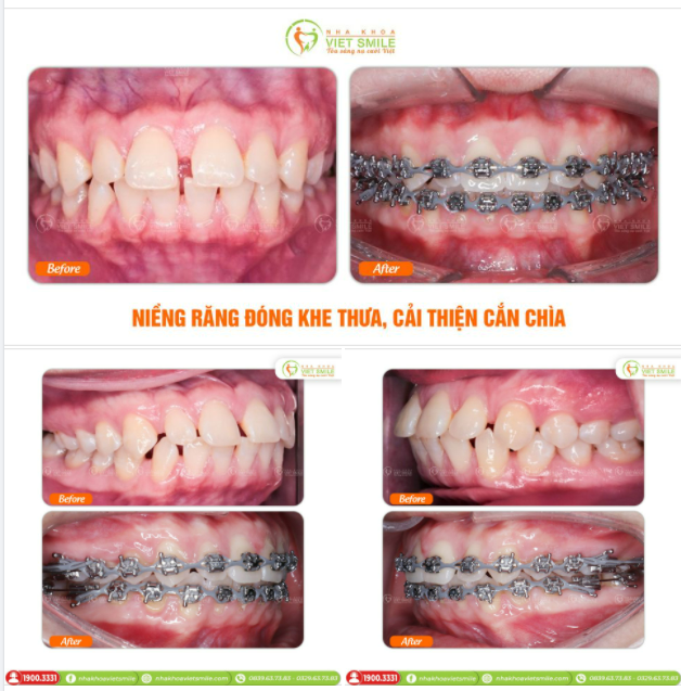 NIỀNG RĂNG ĐÓNG KHE THƯA - GIẢM CẮN CHÌA