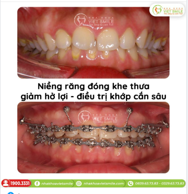 NIỀNG RĂNG ĐÓNG KHE THƯA - GIẢM CƯỜI HỞ LỢI - ĐIỀU TRỊ KHỚP CẮN SÂU