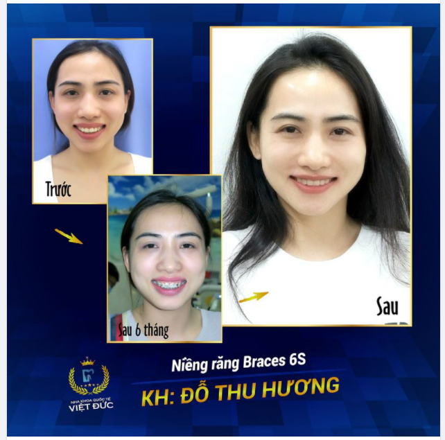 NIỀNG RĂNG HẠNH PHÚC NHẤT LÀ THẤY RĂNG ĐẸP LÊN TỪNG NGÀY!