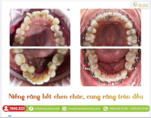 NIỀNG RĂNG HẾT CHEN CHÚC, CUNG RĂNG TRÒN ĐỀU