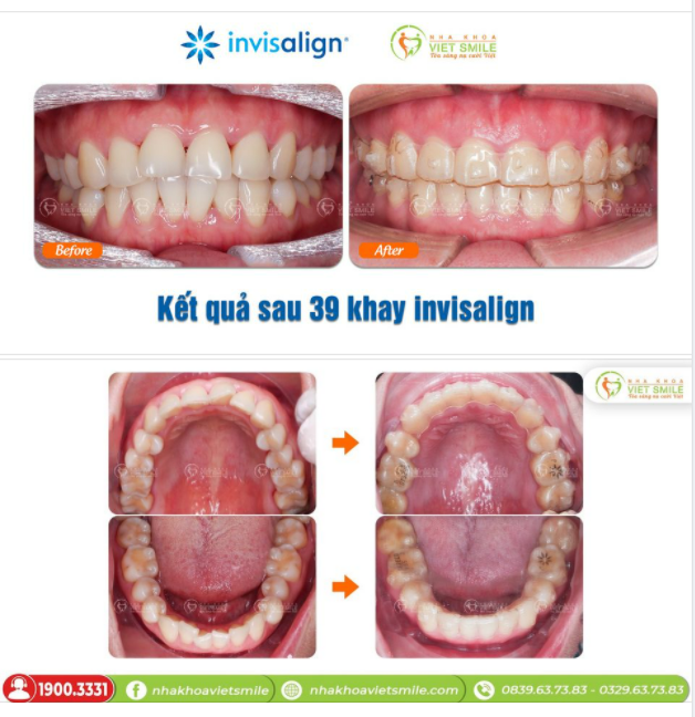 NIỀNG RĂNG HÔ, CHEN CHÚC SAU 50 KHAY INVISALIGN