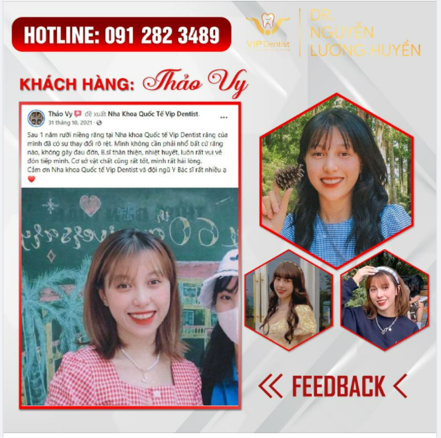 NIỀNG RĂNG HÓA HOT GIRL LÀ NHƯ THẾ NÀO