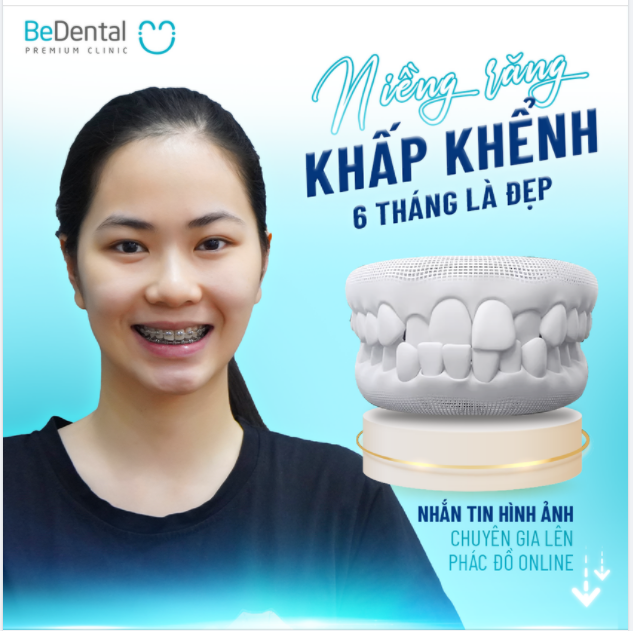NIỀNG RĂNG KHẤP KHỂNH chỉ từ 6 tháng là ĐẸP