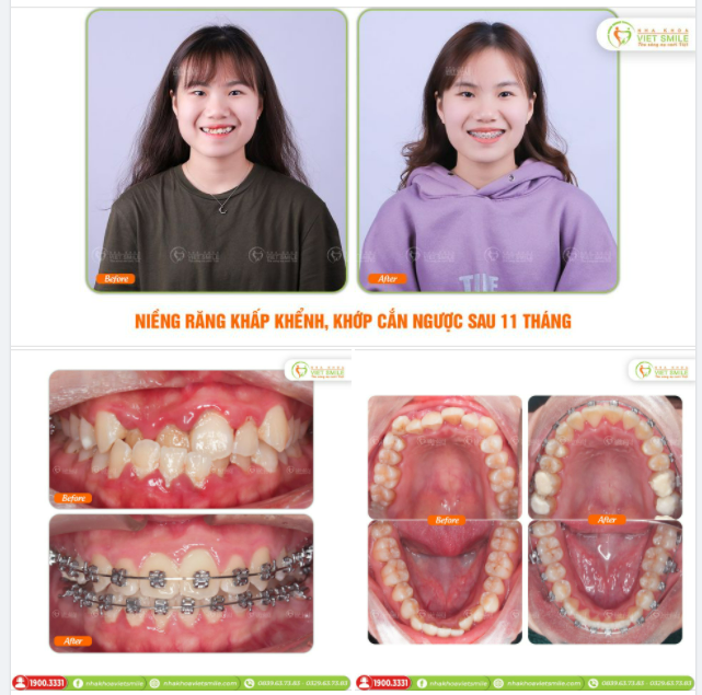 NIỀNG RĂNG KHẤP KHỂNH, KHỚP CẮN NGƯỢC SAU 11 THÁNG