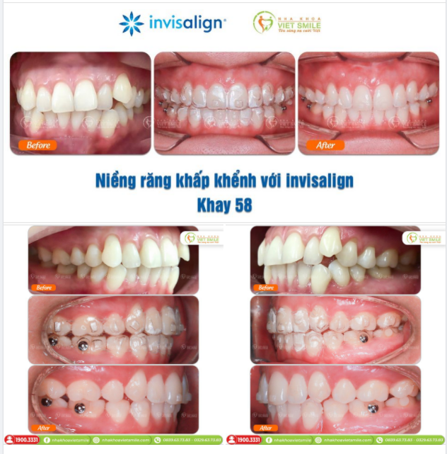 NIỀNG RĂNG KHẤP KHỂNH SAU 58 KHAY INVISALIGN