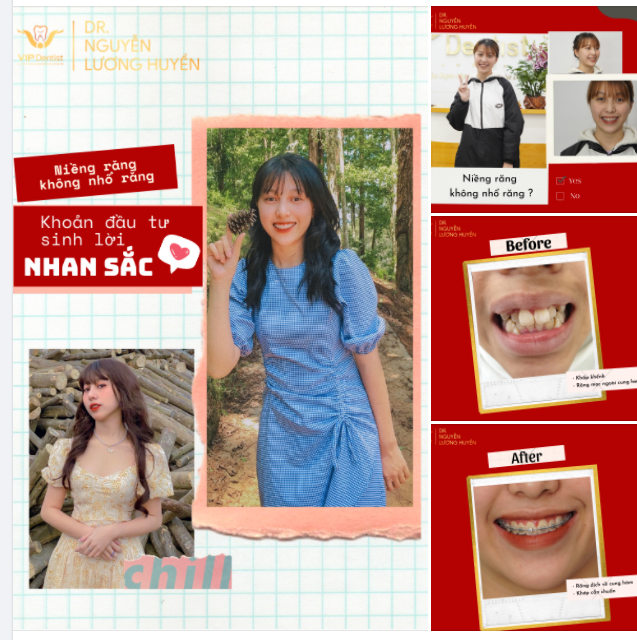 NIỀNG RĂNG KHÔNG NHỔ RĂNG