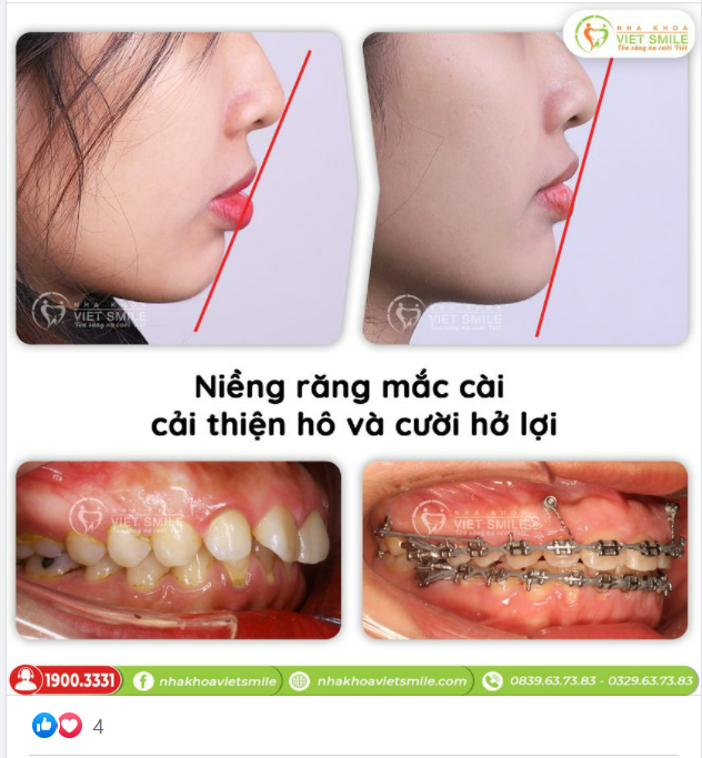 NIỀNG RĂNG MẮC CÀI CẢI THIỆN HÔ VÀ CƯỜI HỞ LỢI
