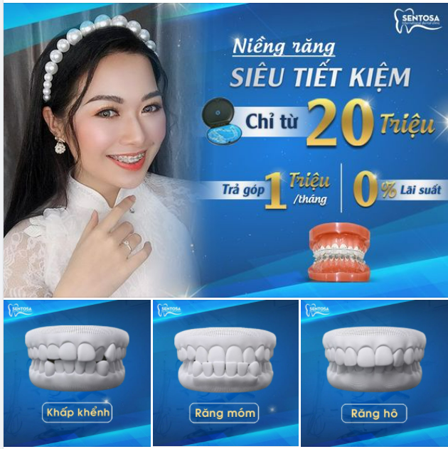 NIỀNG RĂNG MẮC CÀI CHỈ TỪ 20 TRIỆU - RÚT NGẮN 6 THÁNG