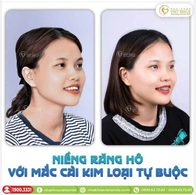 NIỀNG RĂNG MẮC CÀI KIM LOẠI TỰ ĐỘNG - KHẮC PHỤC RĂNG HÔ