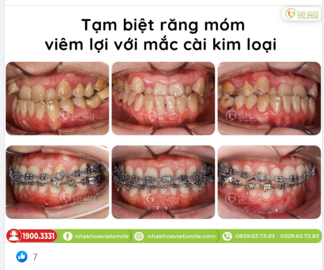NIỀNG RĂNG MẮC CÀI - TẠM BIỆT RĂNG MÓM, VIÊM LỢI